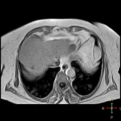 File:Cervical stump squamous cell carcinoma (Radiopaedia 48049-52858 H 18).jpg