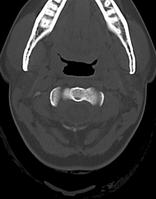 Cervical tuberculous spondylitis (Radiopaedia 39149-41365 Axial bone window 14).png