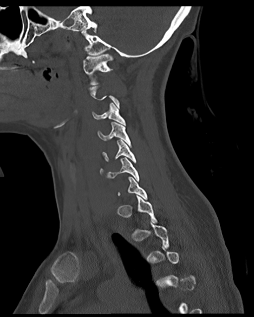 Cervical tuberculous spondylitis (Radiopaedia 39149-41365 Sagittal bone window 23).png