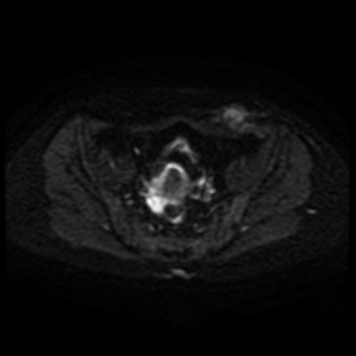 Cesarian section scar endometriosis (Radiopaedia 66520-75799 Axial DWI 33).jpg