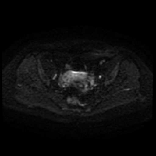 Cesarian section scar endometriosis (Radiopaedia 66520-75799 Axial DWI 62).jpg
