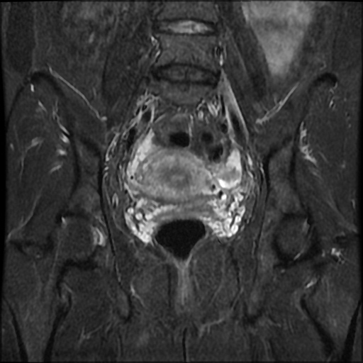 File:Cesarian section scar endometriosis (Radiopaedia 66520-75799 Coronal STIR 20).jpg