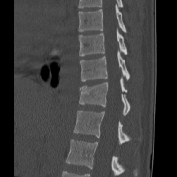 Chance fracture (Radiopaedia 36521-38081 Sagittal bone window 38).jpg