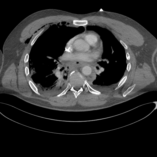 File:Chest multitrauma - aortic injury (Radiopaedia 34708-36147 A 155).png