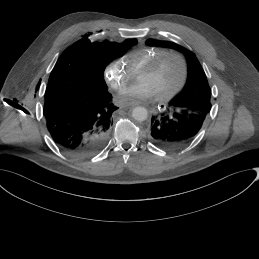 File:Chest multitrauma - aortic injury (Radiopaedia 34708-36147 A 189).png