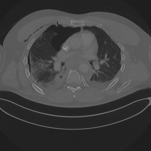 Chest multitrauma - aortic injury (Radiopaedia 34708-36147 Axial bone window 146).png