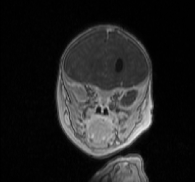 Chiari III malformation with occipital encephalocele (Radiopaedia 79446-92559 Coronal T1 C+ mpr 2).jpg