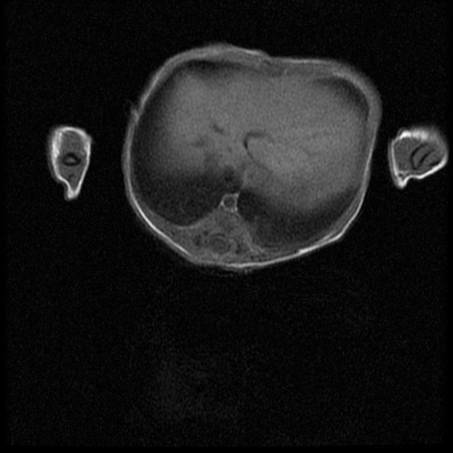 File:Chiari II malformation with spinal meningomyelocele (Radiopaedia 23550-23652 Axial T1 7).jpg