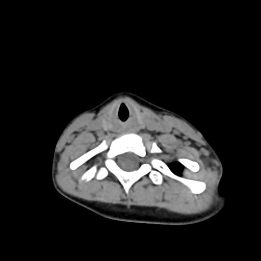 Chiari I with syrinx and skull base anomalies (Radiopaedia 89444-106412 Axial non-contrast 109).jpg