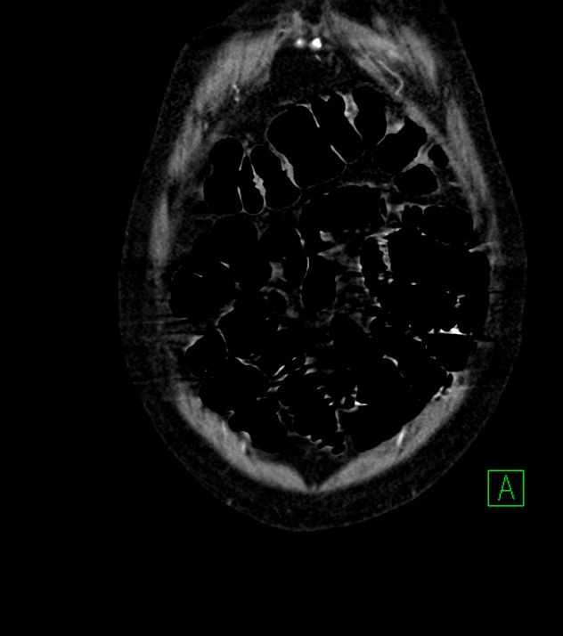 Cholangiocarcinoma with cerebral metastases (Radiopaedia 83519-98629 E 12).jpg