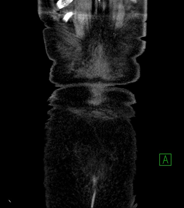 Cholangiocarcinoma with cerebral metastases (Radiopaedia 83519-98629 E 86).jpg