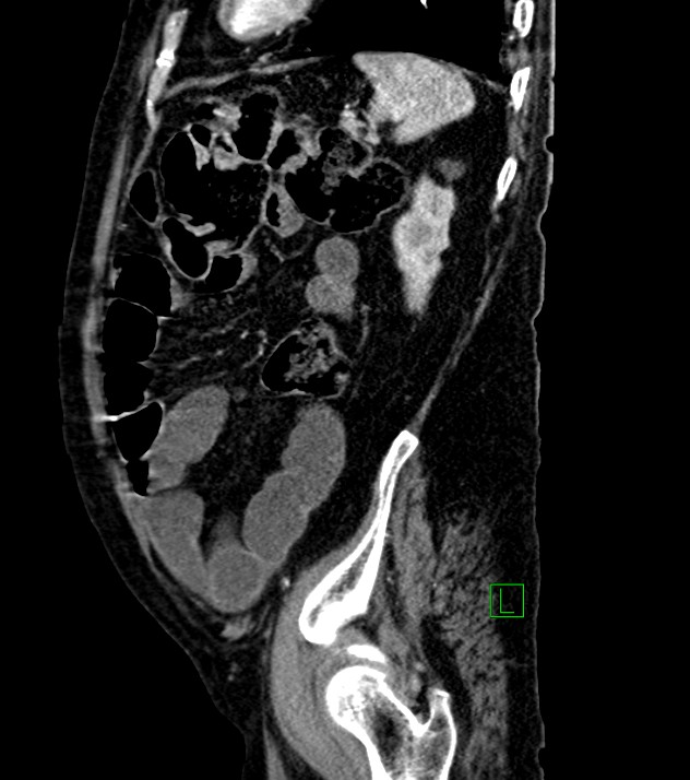 Cholangiocarcinoma with cerebral metastases (Radiopaedia 83519-98629 F 31).jpg