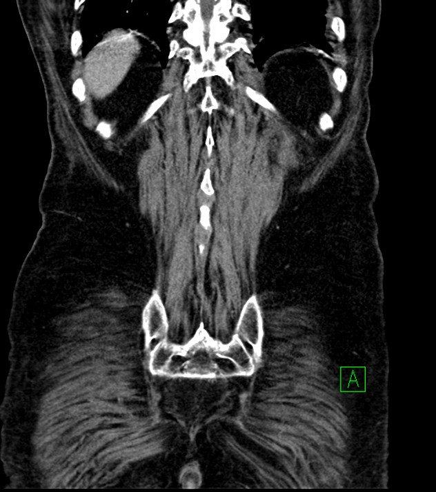 Cholangiocarcinoma with cerebral metastases (Radiopaedia 83519-98629 G 71).jpg