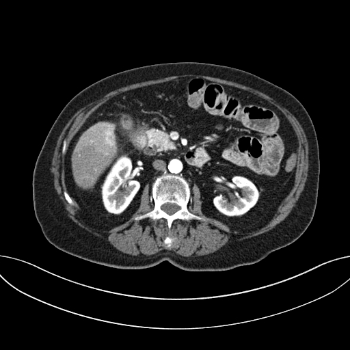 File:Cholecystoduodenal fistula due to calculous cholecystitis with gallstone migration (Radiopaedia 86875-103077 A 31).jpg
