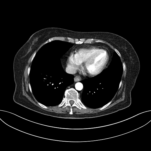 Cholecystoduodenal fistula due to calculous cholecystitis with gallstone migration (Radiopaedia 86875-103077 A 6).jpg