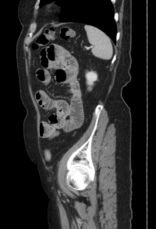 Cholecystoduodenal fistula due to calculous cholecystitis with gallstone migration (Radiopaedia 86875-103077 F 11).jpg