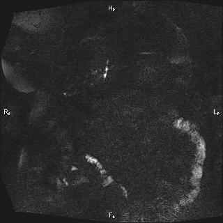 Choledochal cyst - type Ia (Radiopaedia 85673-101454 F 13).jpg