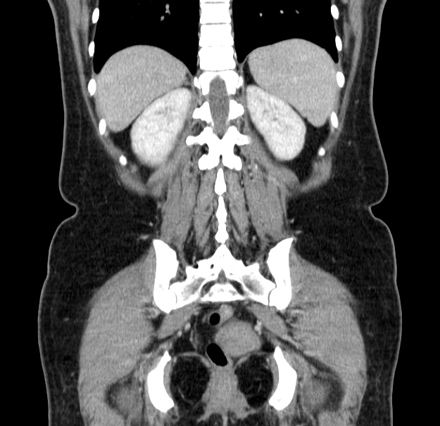 Choledocholithiasis on CT and MRI (Radiopaedia 24825-25087 C 40).jpg