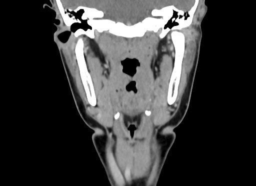Chondroblastic osteosarcoma (Radiopaedia 67363-76741 D 65).jpg