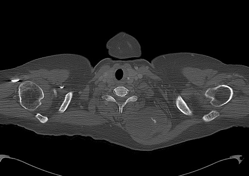 Chondrosarcoma - chest wall (Radiopaedia 65192-74199 Axial bone window 3).jpg