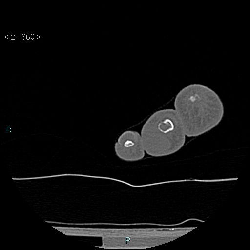 Chondrosarcoma - phalanx (Radiopaedia 69047-78812 Axial bone window 114).jpg