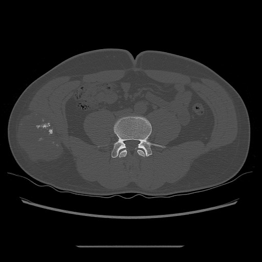 File:Chondrosarcoma of iliac wing (Radiopaedia 63861-72599 Axial bone window 20).jpg