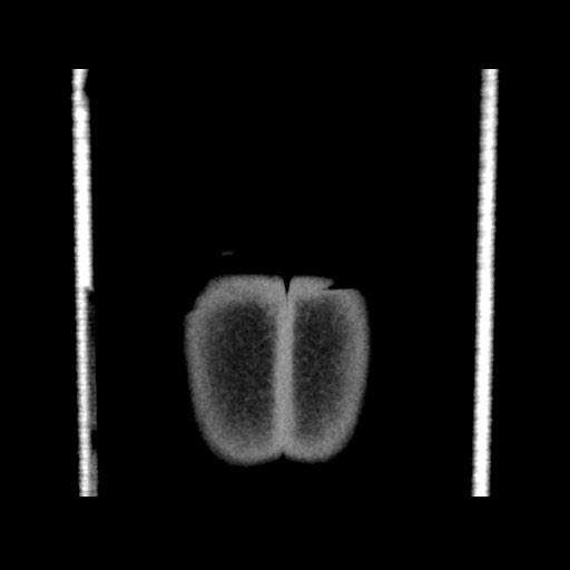 File:Chondrosarcoma of iliac wing (Radiopaedia 63861-72599 Coronal non-contrast 118).jpg