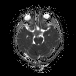 File:Chordoid glioma of third ventricle (Radiopaedia 91612-109340 Axial ADC 11).jpg