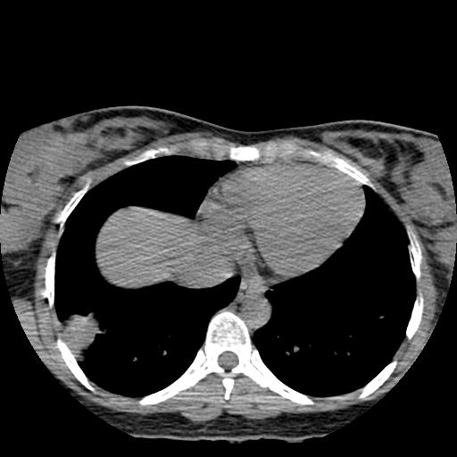 File:Choriocarcinoma of ovary with cerebral and pulmonary metastases (Radiopaedia 25983-26119 Axial non-contrast 18).jpg
