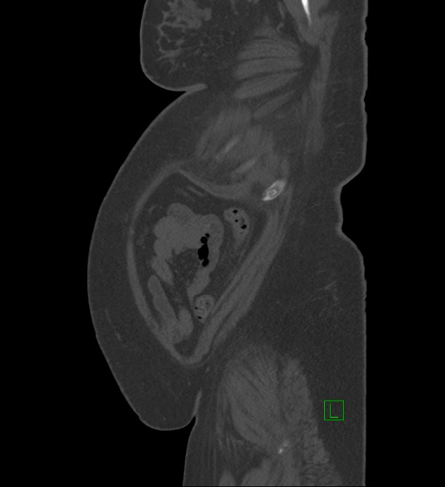Chromophobe renal cell carcinoma (Radiopaedia 84239-99519 Sagittal bone window 8).jpg
