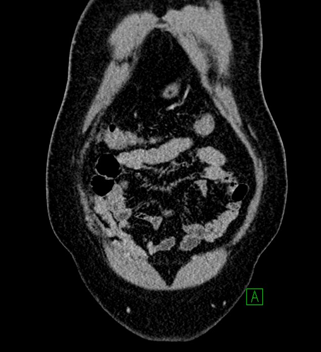 Chromophobe renal cell carcinoma (Radiopaedia 84286-99573 H 27).jpg