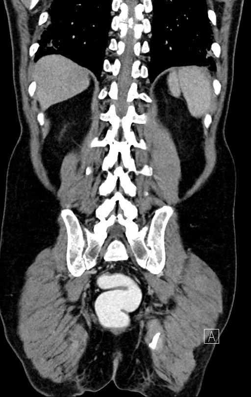 Chronic appendicitis complicated by appendicular abscess, pylephlebitis and liver abscess (Radiopaedia 54483-60700 C 66).jpg