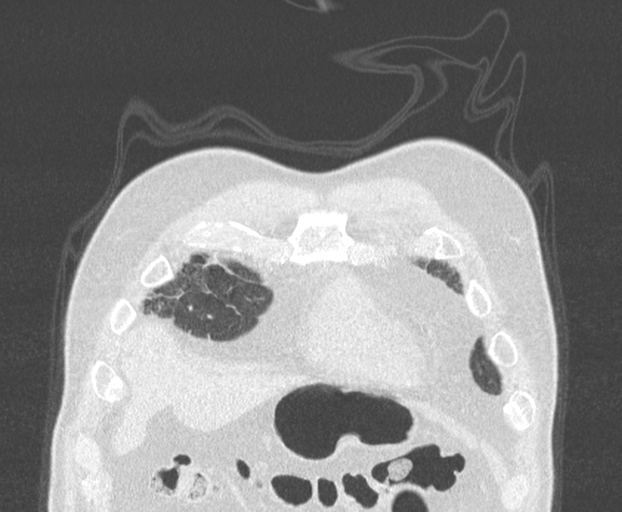 File:Chronic hypersensitivity pneumonitis (Radiopaedia 48107-52922 Coronal lung window 4).png