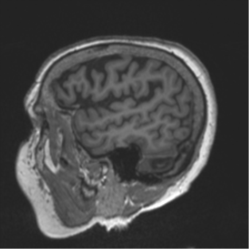 Chronic hypertensive encephalopathy (Radiopaedia 39993-42482 Sagittal T1 22).png