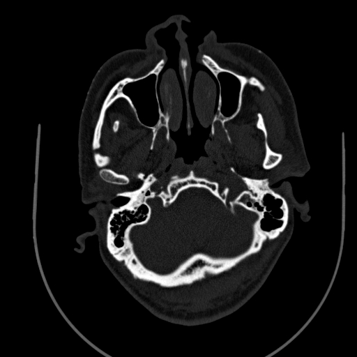Chronic invasive fungal sinusitis (Radiopaedia 91563-109286 Axial sinus 12).jpg