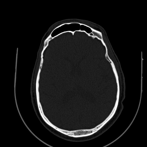 File:Chronic invasive fungal sinusitis (Radiopaedia 91563-109286 Axial sinus 149).jpg