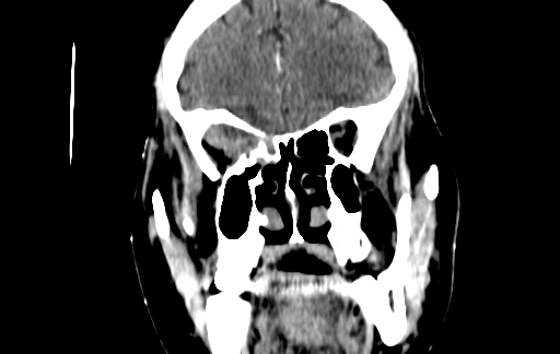 Chronic invasive fungal sinusitis (Radiopaedia 91563-109286 D 52).jpg