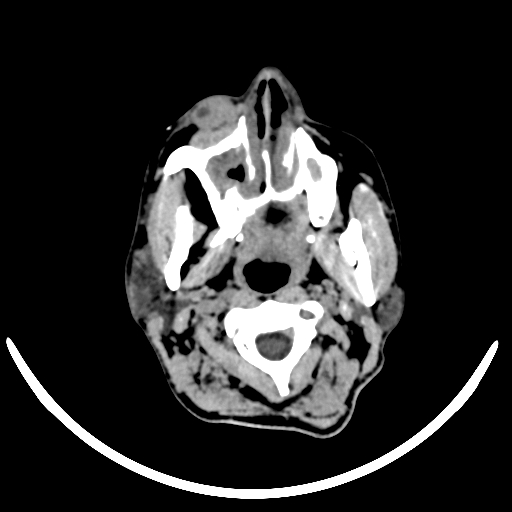 File:Chronic invasive fungal sinusitis with intraorbital and intracranial extension (Radiopaedia 56387-63046 Axial non-contrast 40).jpg
