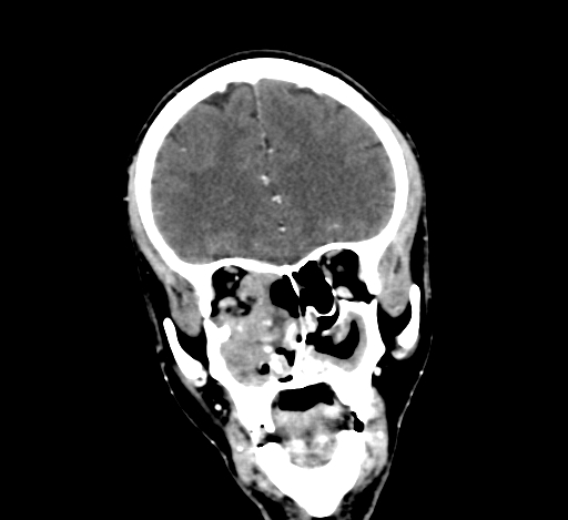 Chronic invasive fungal sinusitis with intraorbital and intracranial extension (Radiopaedia 56387-63046 C 116).jpg