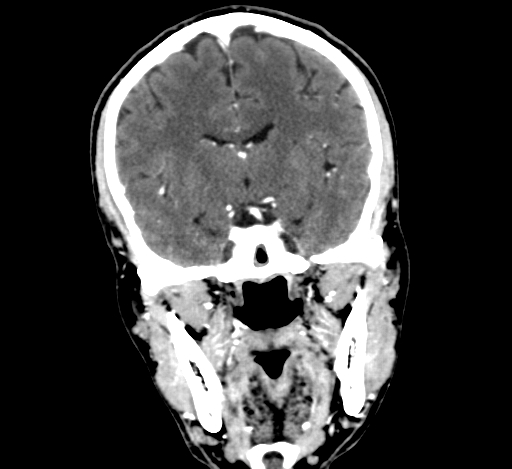 Chronic invasive fungal sinusitis with intraorbital and intracranial extension (Radiopaedia 56387-63046 C 198).jpg