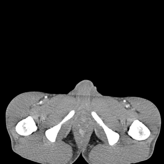 Chronic large bowel pseudo-obstruction (Radiopaedia 43181-46492 A 169).jpg