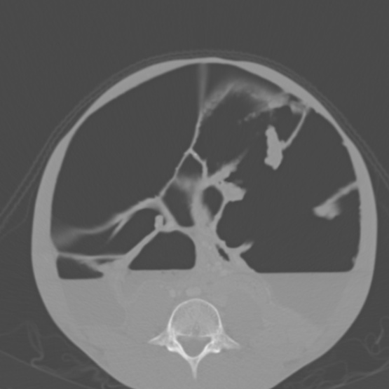 Chronic large bowel pseudo-obstruction (Radiopaedia 43181-46492 Axial bone window 111).jpg