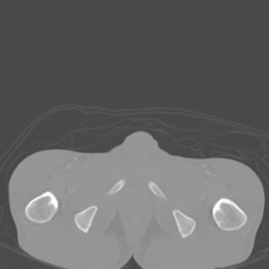 Chronic large bowel pseudo-obstruction (Radiopaedia 43181-46492 Axial bone window 168).jpg