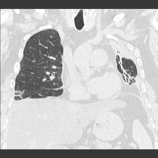 Chronic lung allograft dysfunction - restrictive form (Radiopaedia 60595-68316 Coronal lung window 50).jpg