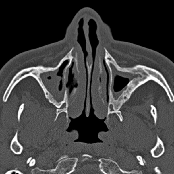 Chronic maxillary sinusitis (Radiopaedia 27879-28116 Axial bone window 14).jpg