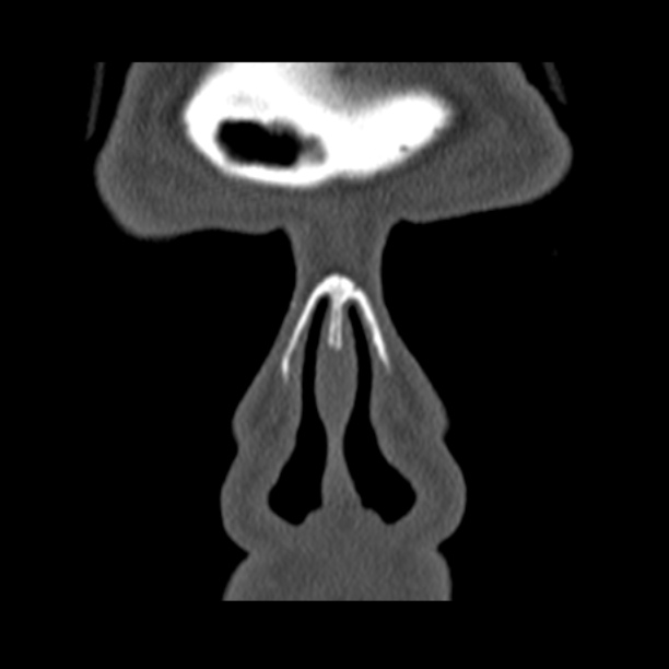 Chronic maxillary sinusitis (Radiopaedia 27879-28116 Coronal bone window 4).jpg