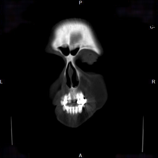 File:Chronic maxillary sinusitis with a foreign body (dental filling material) (Radiopaedia 7811-8639 Coronal bone window 1).jpg