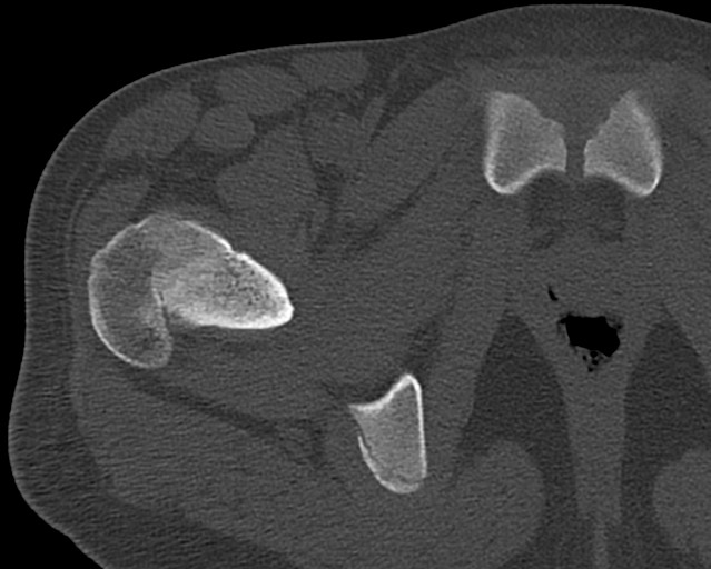 Chronic ostemyelitis of the femur with long sinus tract (Radiopaedia 74947-85982 Axial bone window 9).jpg