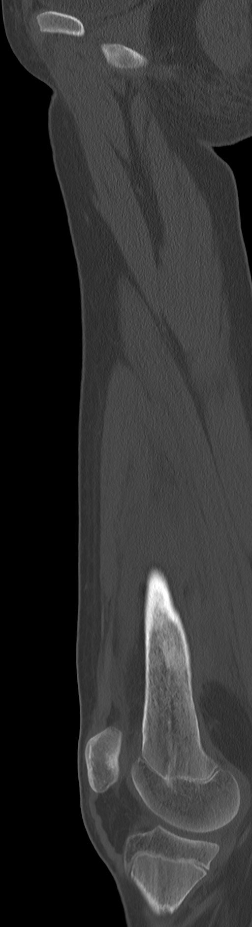 Chronic ostemyelitis of the femur with long sinus tract (Radiopaedia 74947-85982 Sagittal bone window 61).jpg