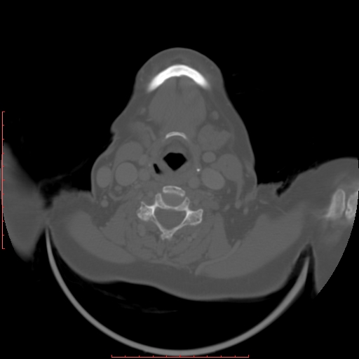 Chronic osteomyelitis - maxilla (Radiopaedia 23783-23927 Axial bone window 3).jpg